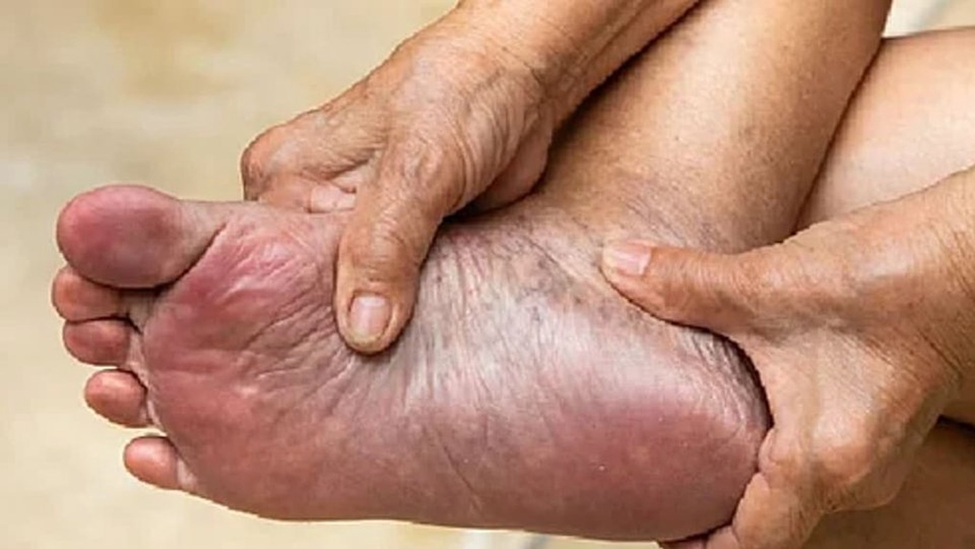 Mani che ispezionano la pianta di un piede, con un arrossamento vicino all'alluce